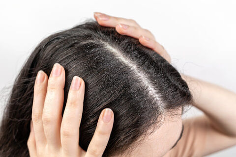 Tips or remedies to overcome dandruff