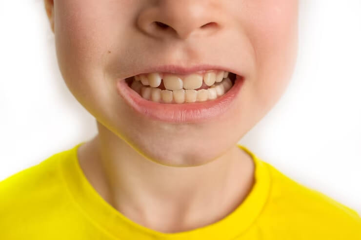 Excellent Hacks to Bust Yellow Tartar from Teeth!