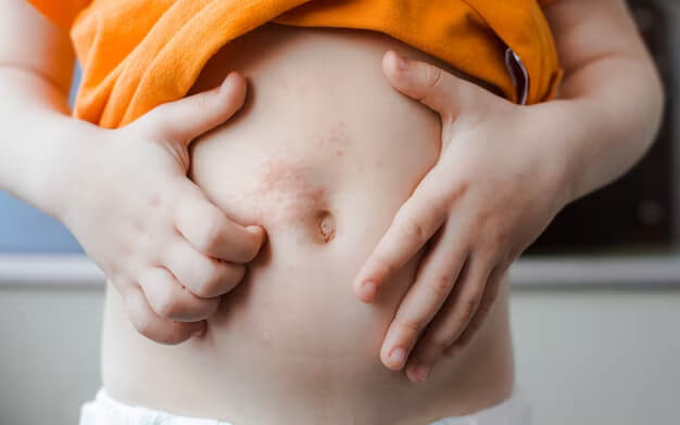 Stretch Mark Solutions: Tips for Minimizing and Preventing Stretch Marks