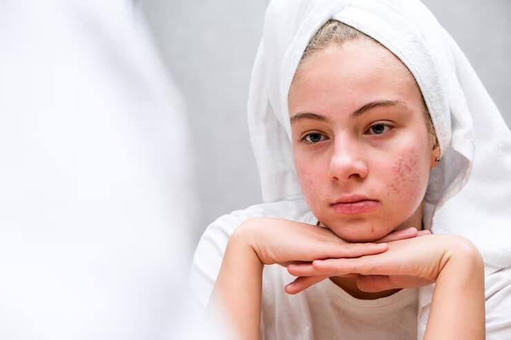 Home 33 Acne and Pimples
